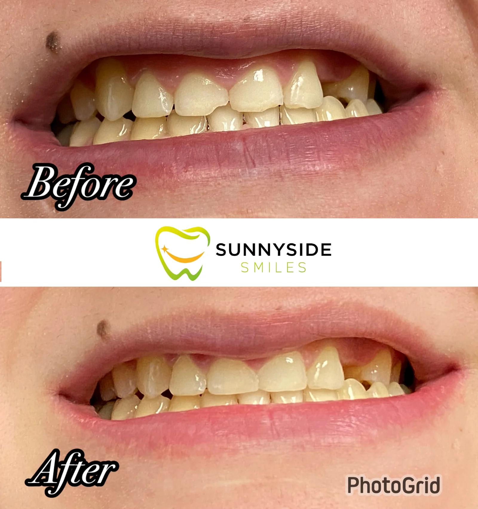 Before and after chipped tooth repair at Sunnyside Smiles