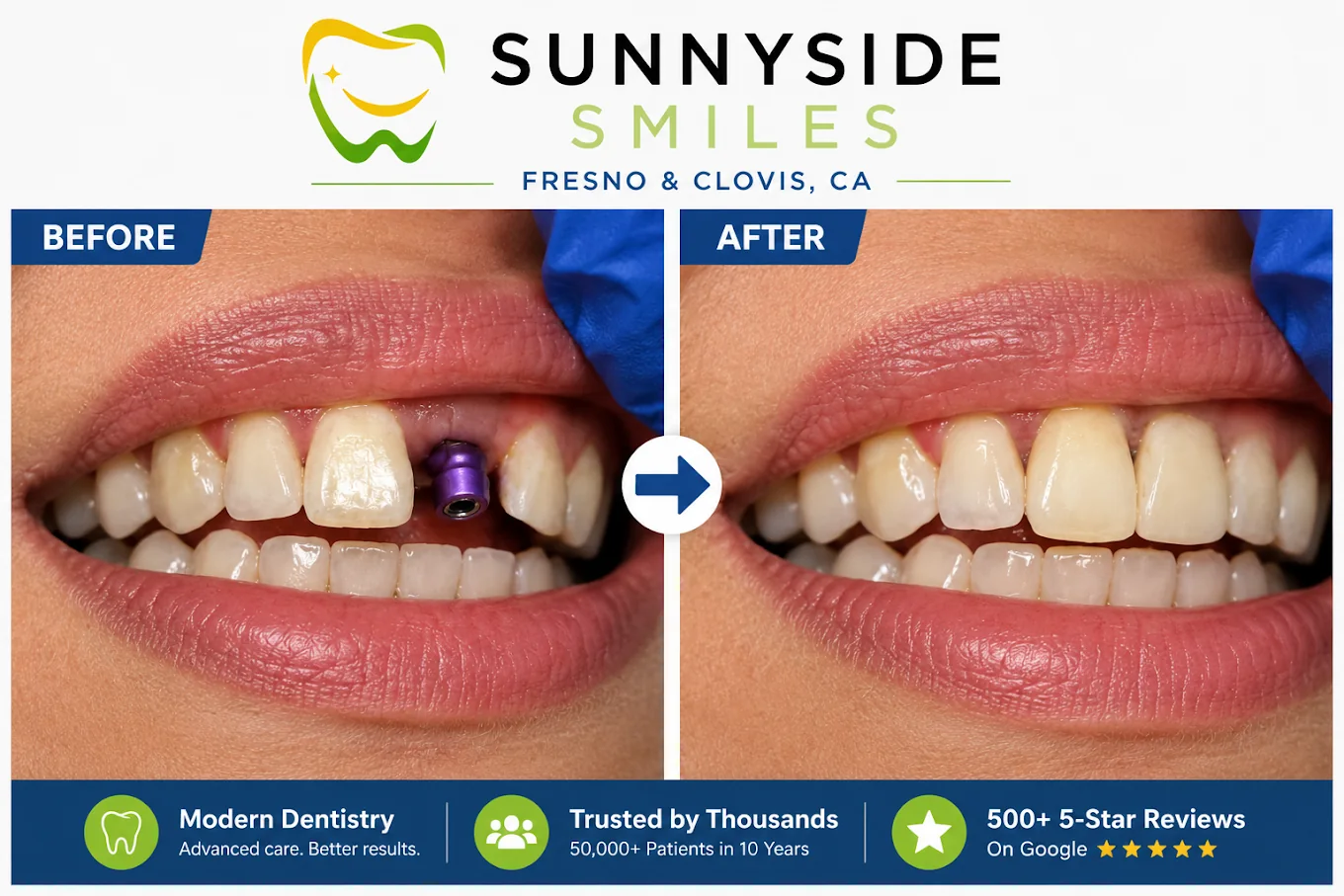 Before and after dental implant replacement for missing front tooth at Sunnyside Smiles