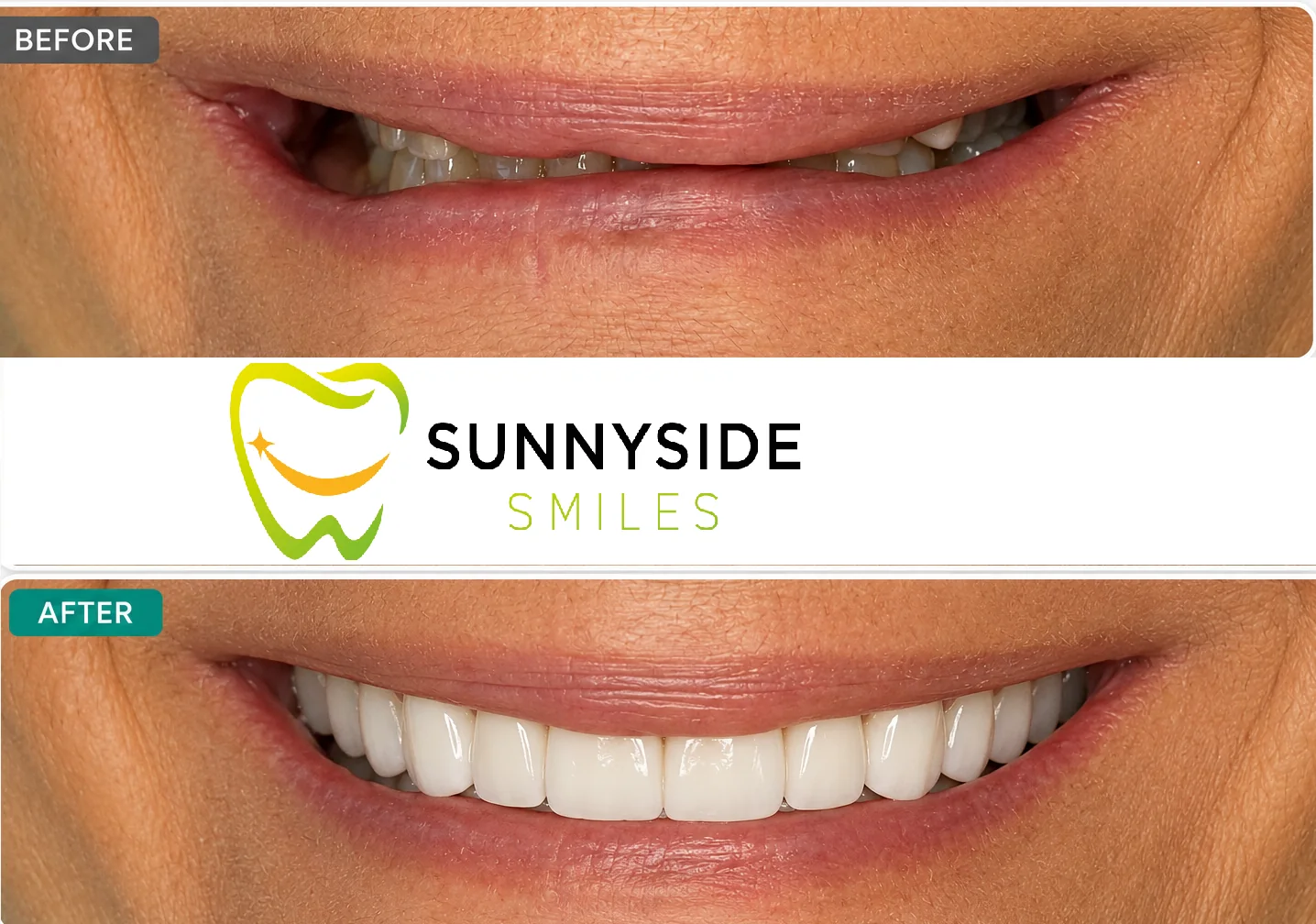 Before and after cosmetic smile makeover with brighter restored teeth at Sunnyside Smiles